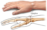 Dorsal Ganglion Cyst