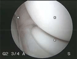 Elbow Arthroscopy