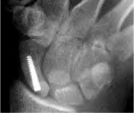 Scaphoid with Acutrak screw