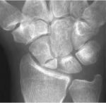 Scaphoid with proximal pole fracture