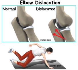 elbow_dislocation_causes01