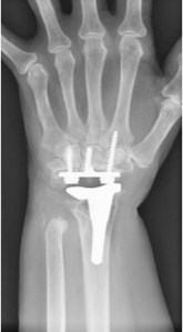 wrist arthroplasty xray