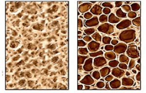 info sheet english osteoporosis