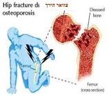 info sheet hebrew hip fracture