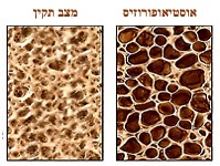 info sheet hebrew osteoporotic